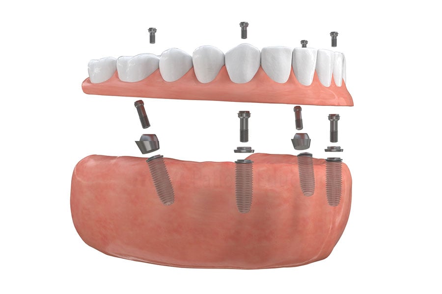 Implant-Supported Bridge near Burr Ridge, IL.