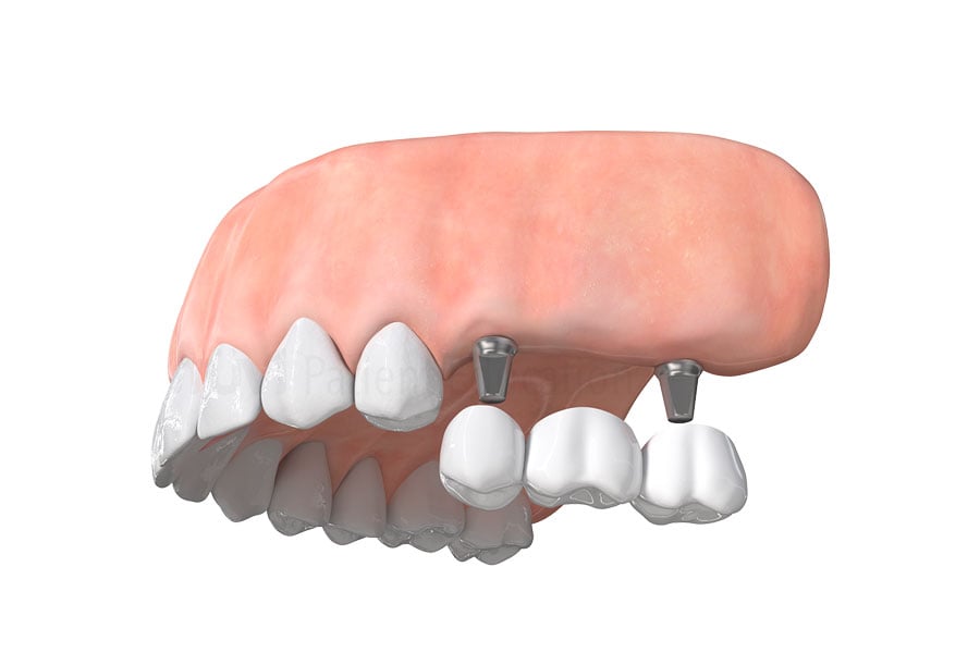 Implanted supported partial dental bridge at our amazing dental practice in Willowbrook, IL near 60561. Implanted Supported Partial Dental Bridge in Willowbrook, IL