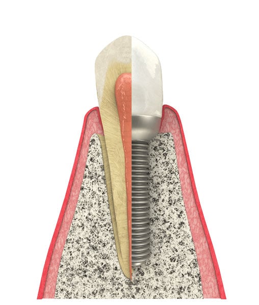 Learn about the key benefits of dental implants from our dental practice near Burr Ridge, IL in 60527. Key Benefits of Dental Implants