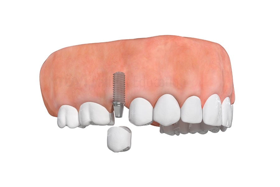 View an image of a single dental implant for when you're missing 1 tooth that can be provided in Willowbrook, IL near 60561. Image of Single Dental Implant