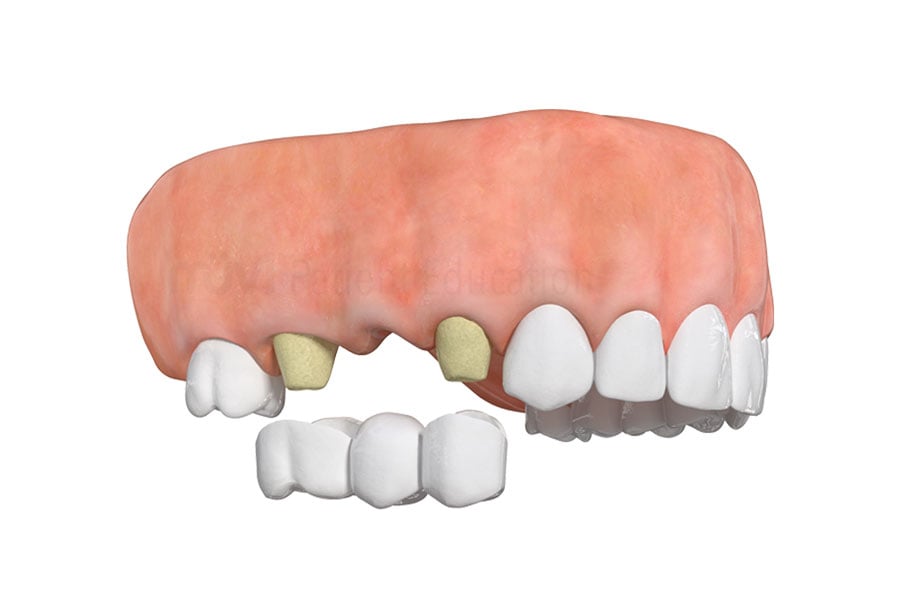 View an image of a dental bridge for when you're missing multiple teeth provided by our exceptional dental team in Willowbrook, IL near 60559. Image of Multiple Tooth Dental Bridge
